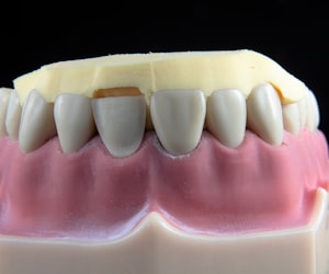 implanted teeth